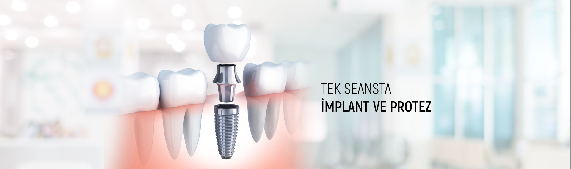 Tek Seansta İmplant